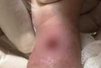 Viral tangan bayi bengkak hingga berlubang usai diinfus di RSIA Paramount Makassar. Foto: (dok. istimewa)


