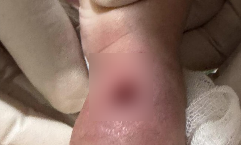 Viral tangan bayi bengkak hingga berlubang usai diinfus di RSIA Paramount Makassar. Foto: (dok. istimewa)


