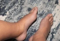 Lipedema vs Lemak Biasa: Kenali Ciri yang Membedakan. (Foto: CNN Indonesia)